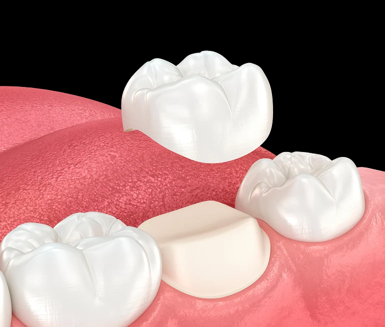 What Are Pediatric Dental Crowns