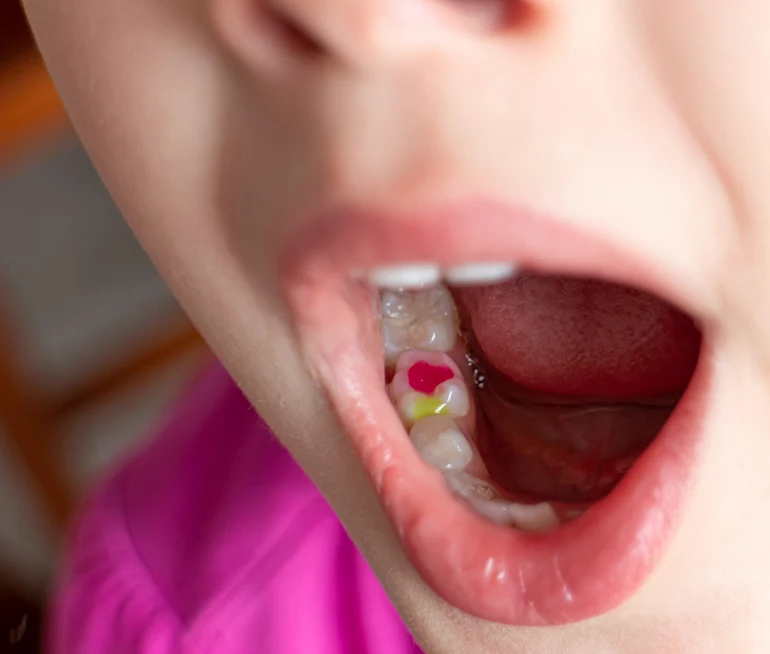 Why Do Children Need Dental Fillings