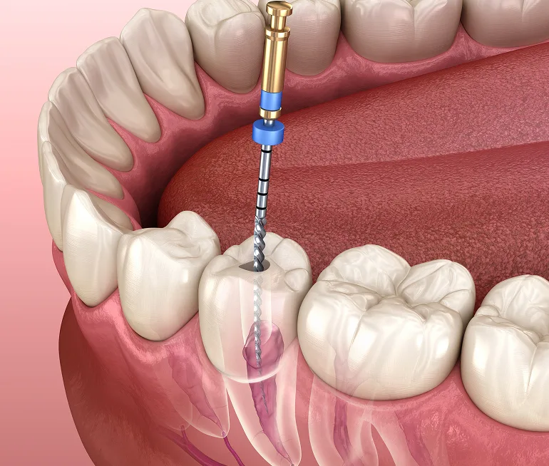 Signs Your Child May Need a Root Canal